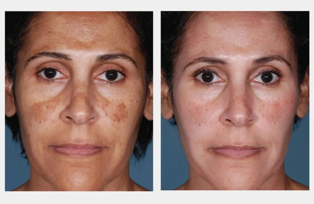 Uneven Complexion and Pigmentation