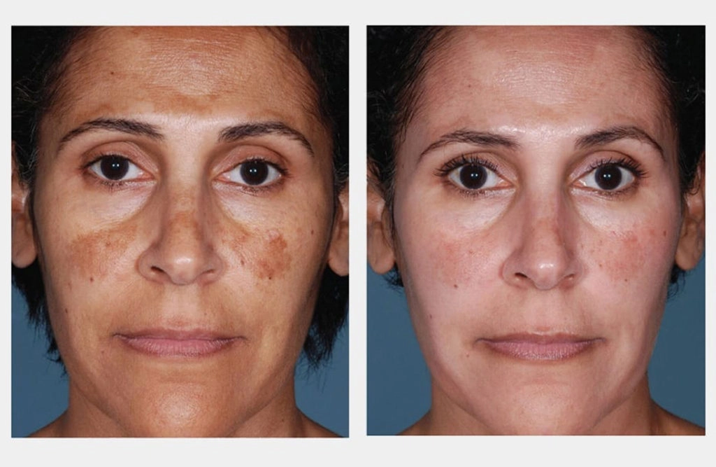 Uneven Complexion and Pigmentation