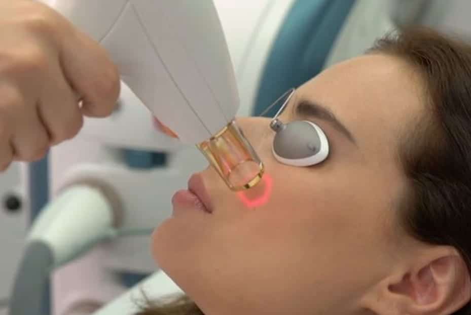 Moxi laser treatment