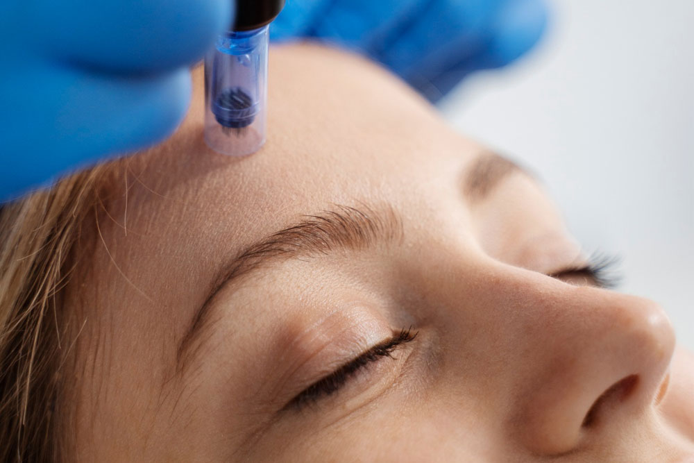 skin resurfacing therapy london