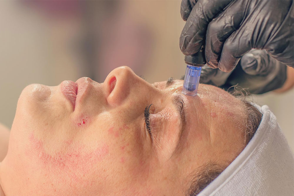 collagen therapy london