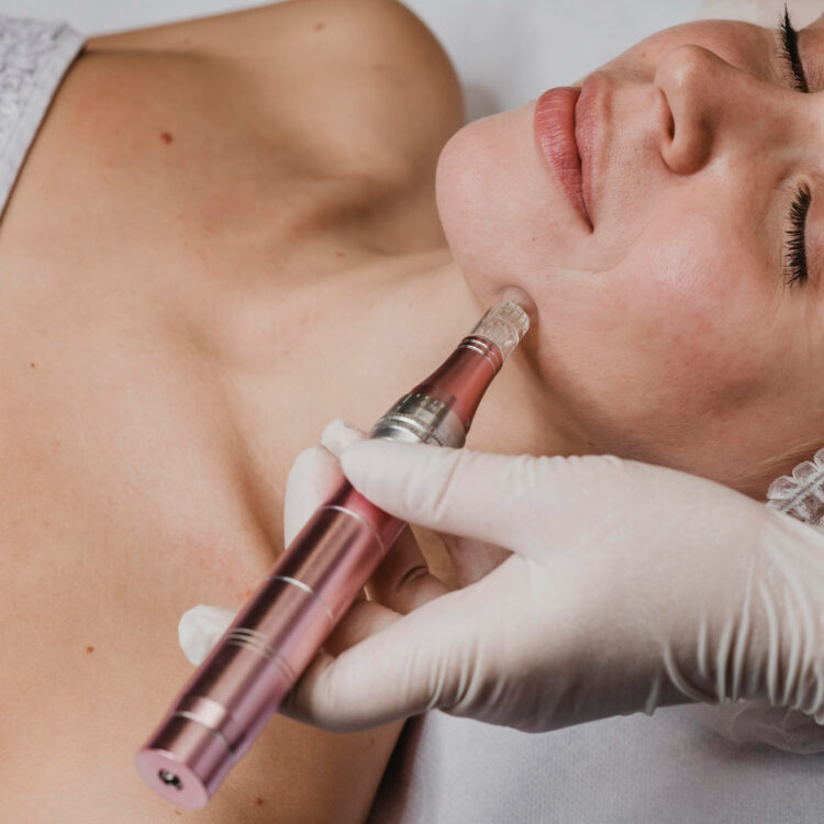 Microneedling in London is the skin trend to watch