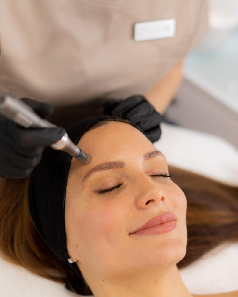 Microneedling treatments in London that fight ageing fast